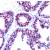 Human breast carcinoma
stained with anti-Progestrone
Receptor