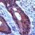 Human colon ca. stained with Anti-TIMP-1 antibody (Cat#AP15821PU).