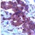 Colon carcinoma stained with Anti-TIMP-2 antibody