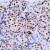 AM11134PU Estrogen Receptor antibody staining of Human breast carcinoma.