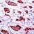 AM11188PU Progesterone Receptor antibody staining of Human breast carcinoma.