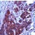 Colon carcinoma stained with Anti-Bcl-xL antibody