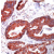 Human colon ca. stained with Anti-HSP60, cat# AP15594PU