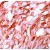 Human melanoma stained with anti-S100 antibody