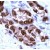Human prostate ca. stained with Anti-AR antibody