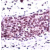 Human breast carcinoma stained with Anti-Akt (pS473), cat# AP15339PU