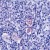 Human Hodgkin’s lymphoma stained with Anti-Bcl-xL