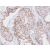 Immunohistochemistry: Paraffin Embedded Sections of Human prostate cancer were incubated with anti-Human TARDBP antibody (1/50) for 2 hours at RT. Antigen retrieval was performed in 0.1 M sodium citrate buffer and detected using Diaminobenzidine (DAB).