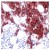 Human breast carcinoma stained with anti-Tau antibody (AM09107PU).