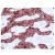 Human breast carcinoma stained with anti-Cytokeratin 18 antibody (AM09115PU)
