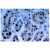 Immunohistochemistry: AM20179AF-N Rad17 antibody staining of Paraffin Embedded Human Lung Adenocarcinoma Section.