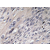Immunohistochemistry analyzes of IRP-1 antibody (AP20312PU-N) in paraffin-embedded human cervix carcinoma tissue.