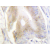 Immunohistochemistry analyzes of IRP-1 antibody in Paraffin-Embedded Human colon carcinoma tissue.