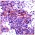 Human lung carcinoma stained with anti-AKT1/2 antibody AP15337PU
