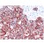 AP15616PU Cytokeratin-18 antibody staining of Human Breast Carcinoma.