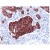 AP15622PU Cytokeratin-7 antibody staining of Human Breast Carcinoma.