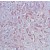 Human breast carcinoma stained with anti-cathepsin D antibody