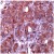 AP15392PU Caspase-10 antibody staining of Human Liver Carcinoma.