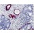 AM11167PU Cytokeratin 5 antibody staining of Human prostate adenocarcinoma.