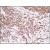 Formalin-Fixed, Paraffin-Embedded Human breast tumor tissue (4 µm) stained with anti-ER antibody (DB 053) shows strong positive nuclear  immunostaining. Kindly performed and provided by Katarína Poliaková, MD and Ľubomír Straka, MD, Ph. D., from Clinical Pathology Prešov, Ltd., Prešov, Slovak republic.