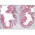 Staining of paraffin embedded Human Prostate using KLK2 Antibody Cat.-No AP16632PU-N at 3.8 µg/ml. Steamed antigen retrieval with citrate buffer pH 6, AP-staining.