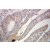 Immunohistochemistry of paraffin-embedded Colon cancer using 10226-1-AP(ABCF2 Antibody) at Dilution 1:100 (under 25x lens)