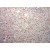 Immunohistochemistry of paraffin-embedded Breast cancer using 10237-1-AP(S100A11 Antibody) at Dilution 1:50 (under 10x lens)