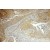 Immunohistochemistry of paraffin-embedded Cervical cancer using 10371-2-AP(MMP1 Antibody) at Dilution 1:50 (under 10x lens)