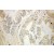 Immunohistochemistry of paraffin-embedded Pancreas cancer using 10488-1-AP(HSD3B7 Antibody) at Dilution 1:50 (under 10x lens)