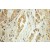 Immunohistochemistry of paraffin-embedded Pancreas cancer using 10510-1-AP(BLK Antibody) at Dilution 1:10 (under 10x lens)