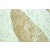 Immunohistochemistry of paraffin-embedded Prostate cancer using 10590-1-AP(KRT6A Antibody) at Dilution 1:100 (under 25x lens)