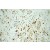 Immunohistochemistry of paraffin-embedded Pancreas cancer using 10678-1-AP(RGS2 Antibody) at Dilution 1:50 (under 10x lens)