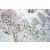 Immunohistochemistry of paraffin-embedded Colon cancer using 10736-1-AP(VCP Antibody) at Dilution 1:100 (under 10x lens)
