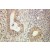 Immunohistochemistry of paraffin-embedded Ovary tumor using 10753-1-AP(TIMP1 Antibody) at Dilution 1:100 (under 10x lens)