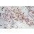 Immunohistochemistry of paraffin-embedded Breast cancer using 10830-1-AP(KRT18 Antibody) at Dilution 1:100 (under 10x lens)