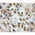 Immunohistochemistry of paraffin-embedded Prostate cancer using 11144-1-AP(P2RX7 Antibody) at Dilution 1:50 (under 10x lens)