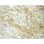 Immunohistochemistry of paraffin-embedded Lung cancer using 11159-1-AP(ABCD1 Antibody) at Dilution 1:50 (under 10x lens)