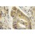 Immunohistochemistry of paraffin-embedded Colon cancer using 11306-1-AP(Beclin 1 Antibody) at Dilution 1:50 (under 10x lens)