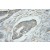 Immunohistochemistry of paraffin-embedded Pancreas cancer using 11405-1-AP(HSP90AB1 Antibody) at Dilution 1:50 (under 10x lens)