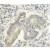 Immunohistochemistry of paraffin-embedded Colon cancer using 11491-1-AP(ACCS Antibody) at Dilution 1:50 (under 10x lens)
