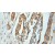 Immunohistochemistry of paraffin-embedded Pancreas cancer using 11856-1-AP(CASP4 Antibody) at Dilution 1:50 (under 25x lens)