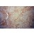 Immunohistochemistry of paraffin-embedded Liver cancer using 14427-1-AP(APOA1 Antibody) at Dilution 1:100 (under 10x lens)