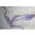 Immunohistochemistry of paraffin-embedded Skin Cancer using 15146-1-AP(S100B Antibody) at Dilution 1:100 (under 10x lens)