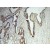 Immunohistochemistry of paraffin-embedded Breast cancer using 17873-1-AP(MMP3 Antibody) at Dilution 1:100 (under 10x lens)