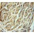 Immunohistochemistry of paraffin-embedded Ovary cancer using 51008-2-AP(ABCE1 Antibody) at Dilution 1:50 (under 10x lens)