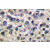 Immunohistochemistry (IHC) analyzes of MMP-14  antibody in paraffin-embedded human breast carcinoma tissue.