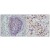 Immunohistochemical analysis of paraffin-embedded human esophageal cancer (left) and lung cancer (right), showing nuclear localization using p53 antibody Cat.-No AM06330SU-N with DAB staining.