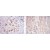 Immunohistochemical analysis of paraffin-embedded breast cancer tissues (left) and cardiac muscle tissues (right) using HSP27 mouse mAb with DAB staining.