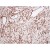 Immunohistochemistry: Paraffin embedded sections of human renal cell carcinoma tissue were incubated with anti-human Clusterin antibody Cat.-No AM09004PU-N (1/100) for 2 hours at room temperature. Antigen retrieval was performed in 0.1 M sodium citrate buffer and detected using Diaminobenzidine (DAB).