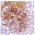 Human lung carcinoma stained with anti-GLUT1 antibody